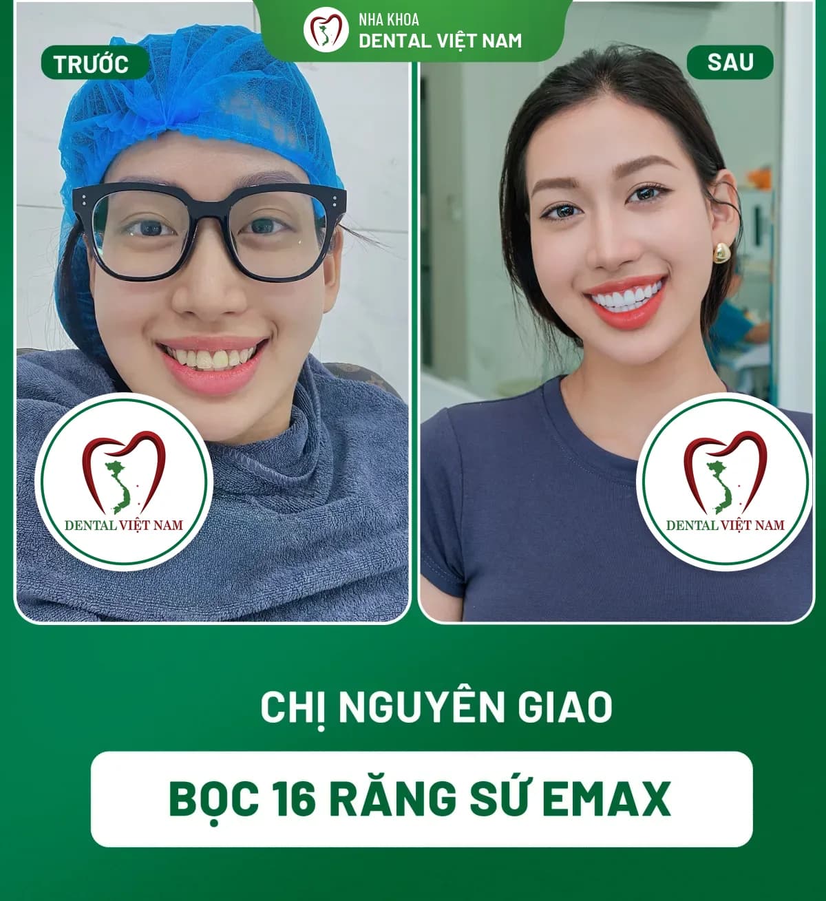 Ảnh trước và sau của Chị Nguyên Giao — Bọc 16 răng sứ Emax tại Nha khoa Dental Việt Nam