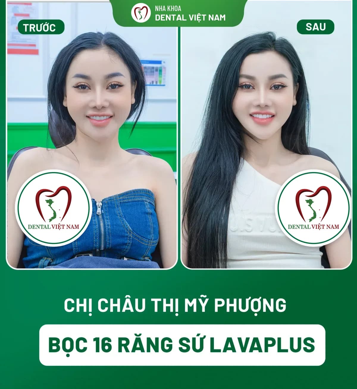 Ảnh trước và sau của Chị Châu Thị Mỹ Phượng — Bọc 16 răng sứ LavaPlus tại Nha khoa Dental Việt Nam