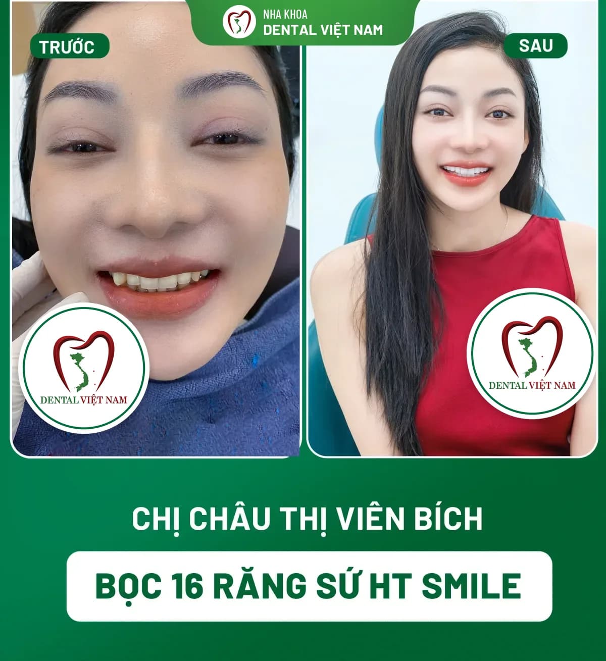 Ảnh trước và sau của Chị Châu Thị Viên Bích — Bọc 16 răng sứ HT Smile tại Nha khoa Dental Việt Nam