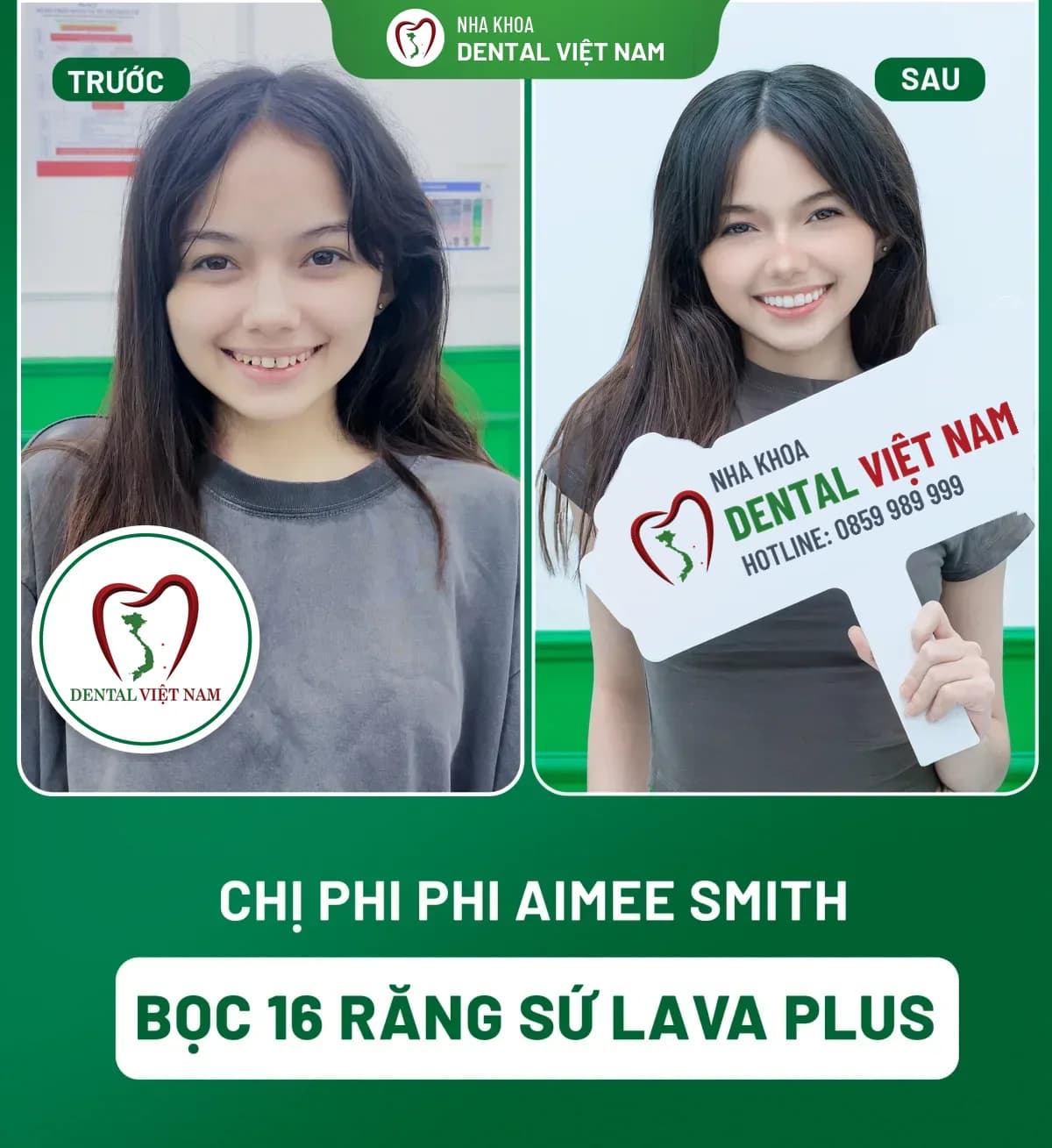 Ảnh trước và sau của Chị Phi Phi Aimee Smith — Bọc 16 răng sứ Lava Plus tại Nha khoa Dental Việt Nam