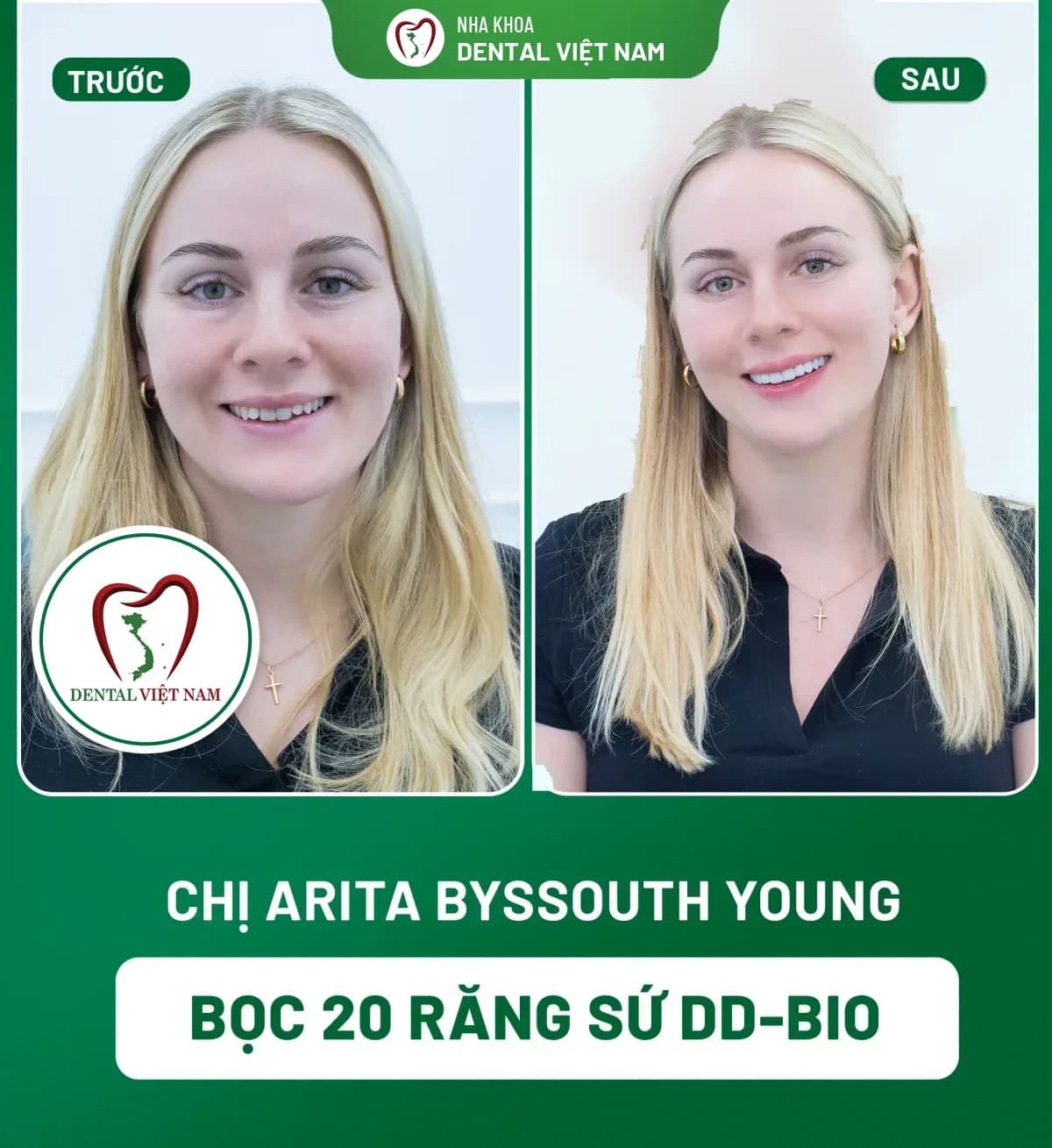 Ảnh trước và sau của Chị Arita Byssouth Young — Bọc 20 răng sứ DD-Bio tại Nha khoa Dental Việt Nam