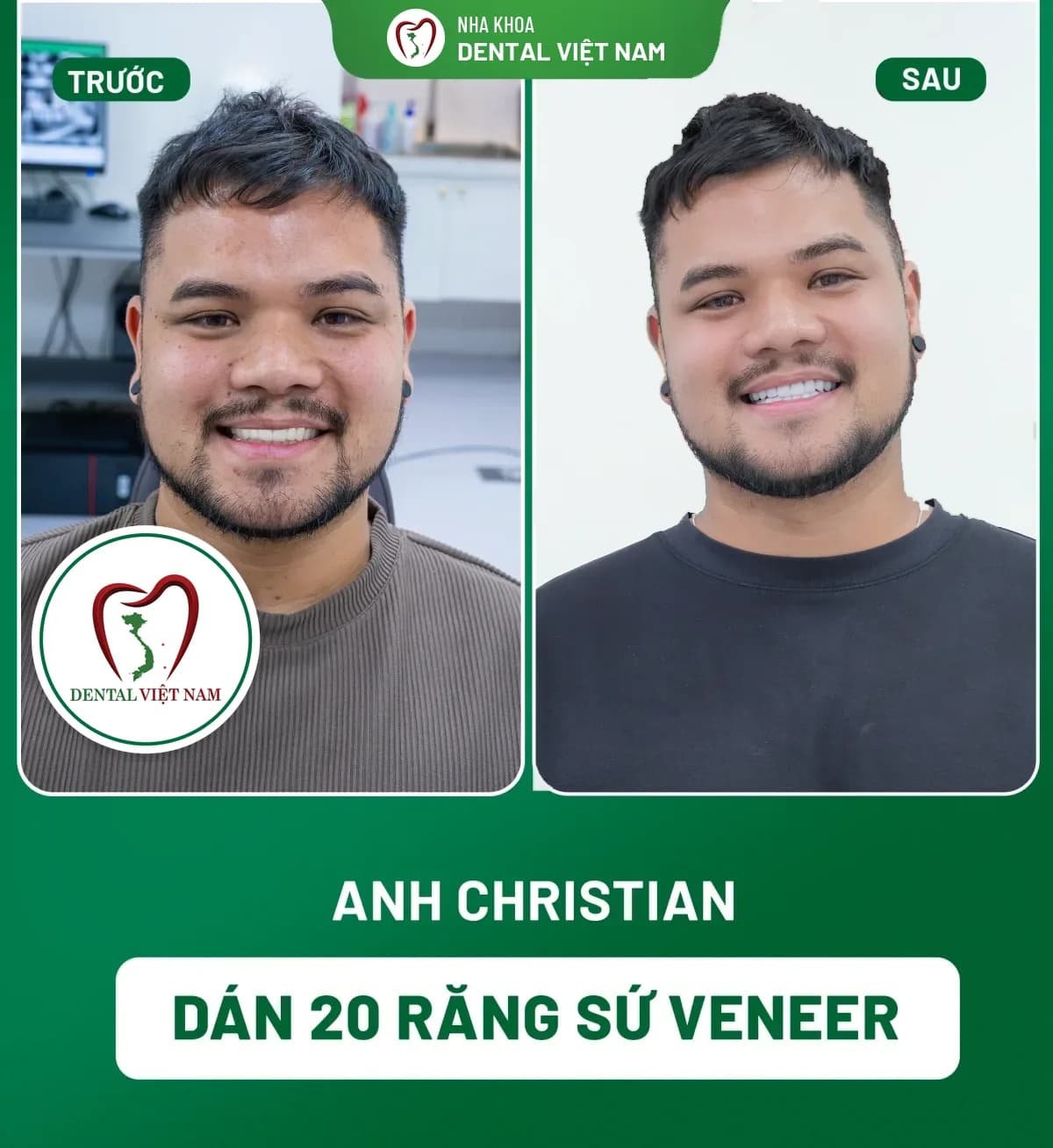 Ảnh trước và sau của Anh Christian — Dán 20 răng sứ Veneer tại Nha khoa Dental Việt Nam