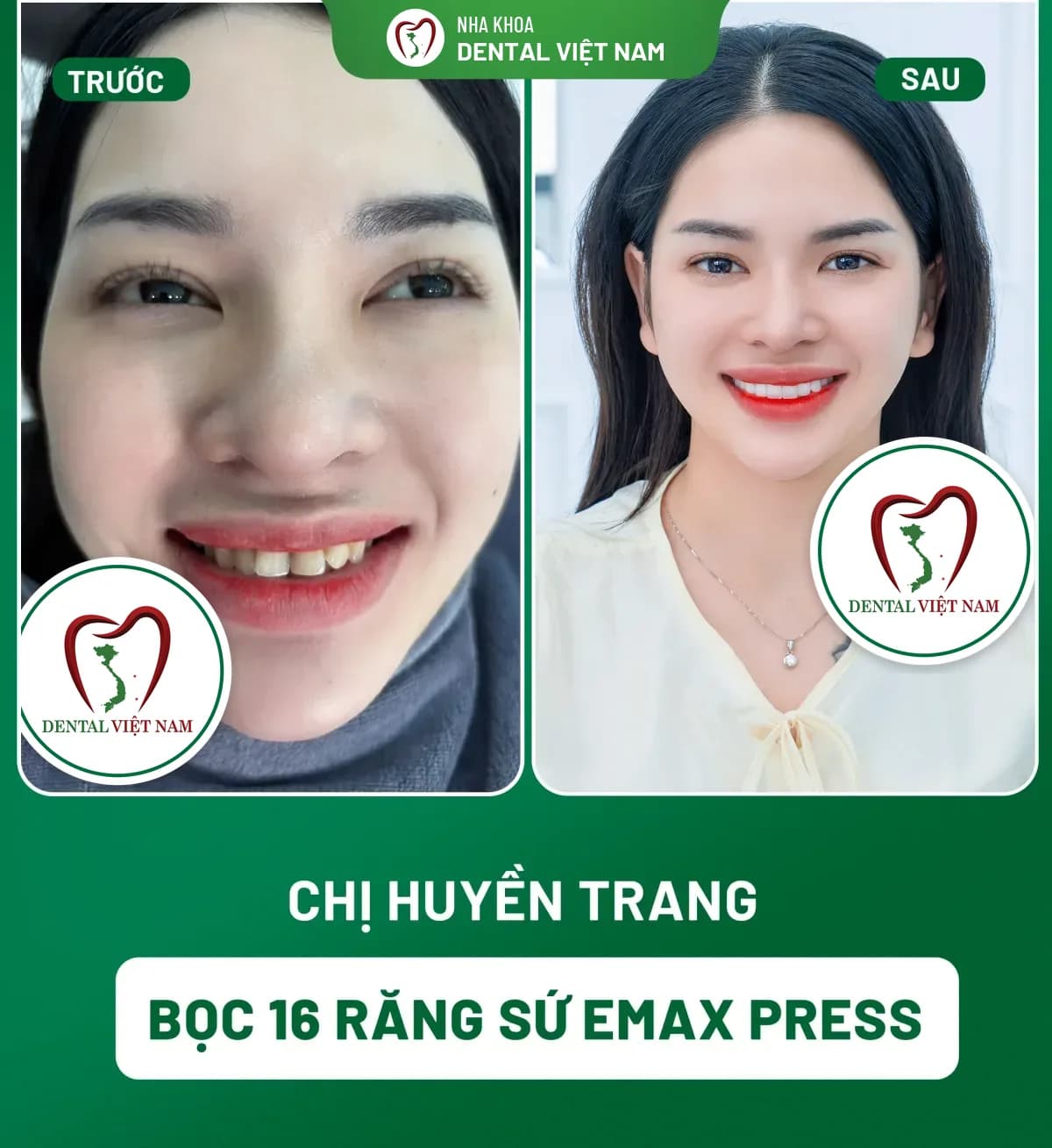 Ảnh trước và sau của Chị Huyền Trang — Bọc 16 răng sứ Emax Press tại Nha khoa Dental Việt Nam