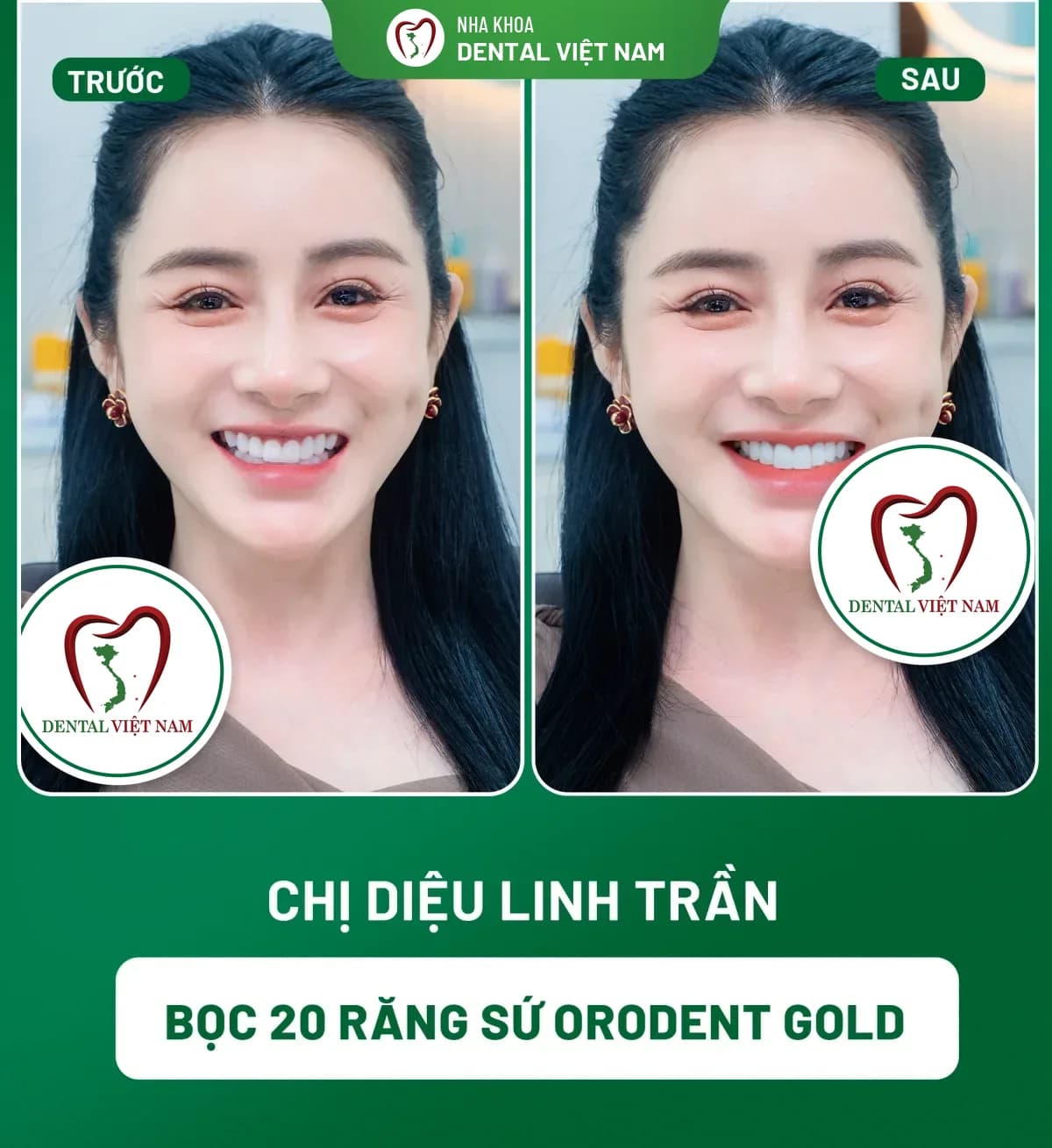 Ảnh trước và sau của Chị Diệu Linh Trần — Bọc 20 răng sứ Orodent Gold tại Nha khoa Dental Việt Nam