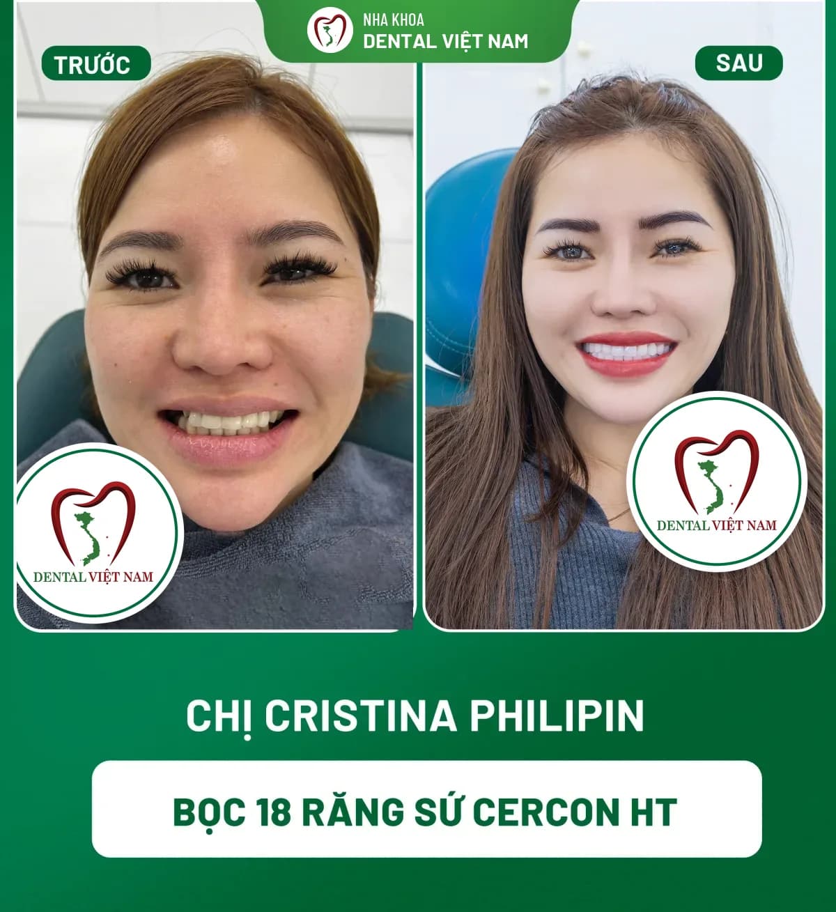 Ảnh trước và sau của Chị Cristina Philipin — Bọc 18 răng sứ Cercon HT tại Nha khoa Dental Việt Nam
