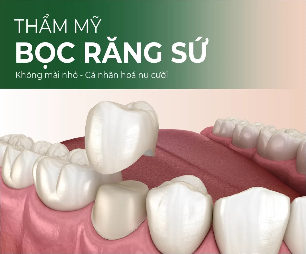 Porcelain crowns illustration