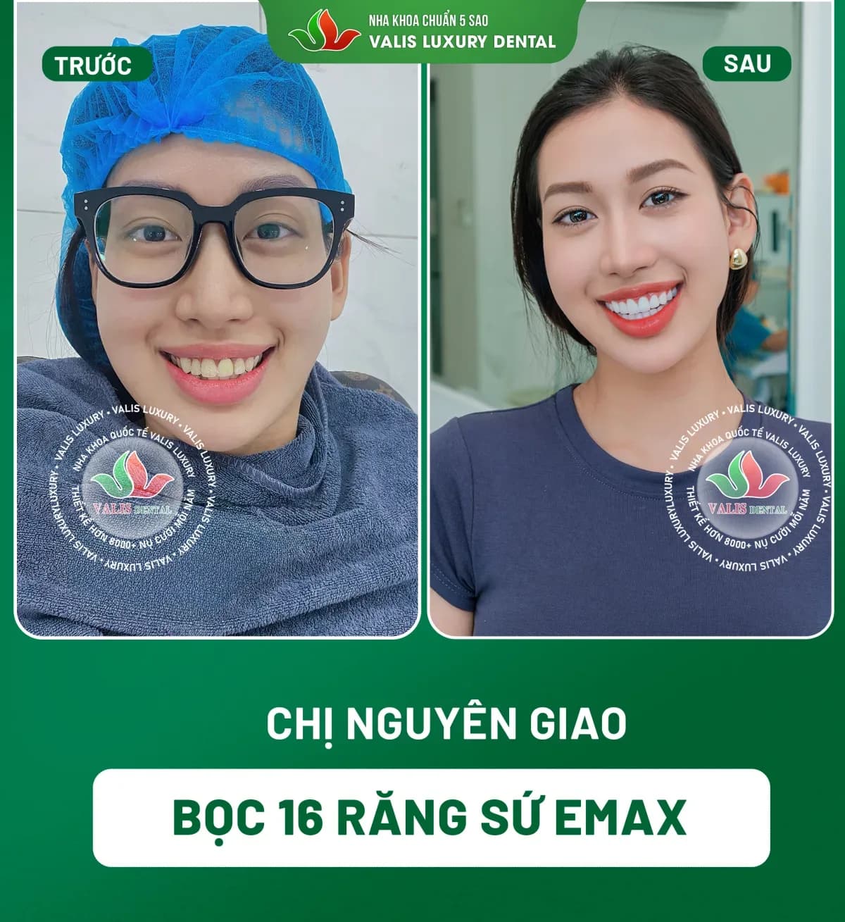 Before and after photographs of Nguyên Giao — 16 Emax porcelain crowns at Dental Việt Nam