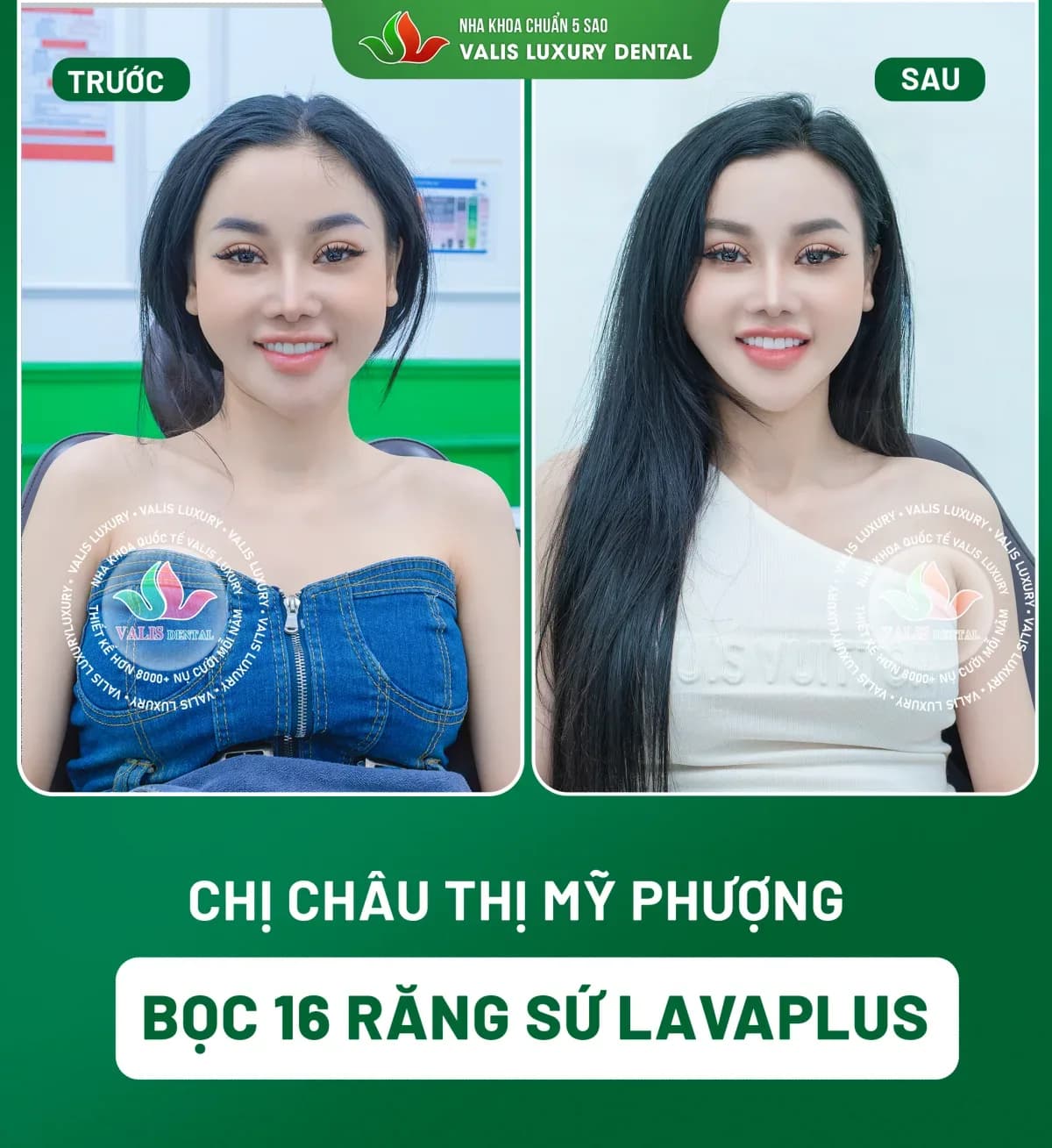 Before and after photographs of Châu Thị Mỹ Phượng — 16 Lava Plus porcelain crowns at Dental Việt Nam
