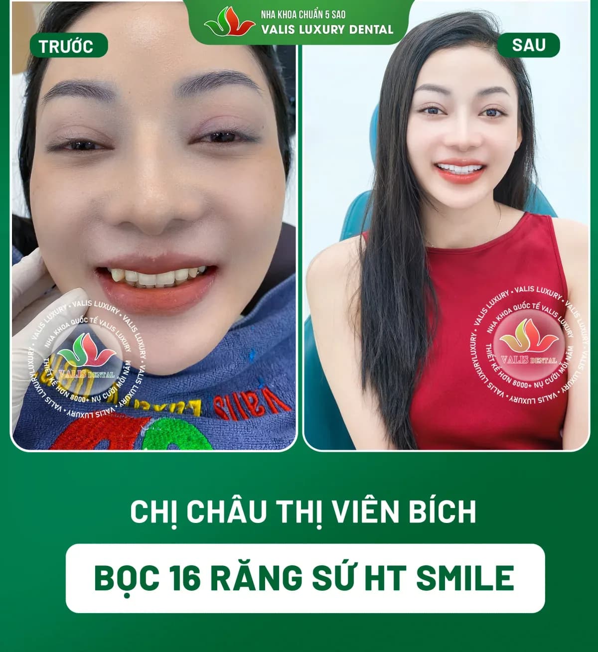 Before and after photographs of Châu Thị Viên Bích — 16 HT Smile porcelain crowns at Dental Việt Nam