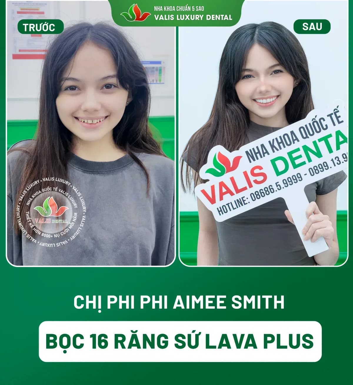 Before and after photographs of Phi Phi Aimee Smith — 16 Lava Plus porcelain crowns at Dental Việt Nam