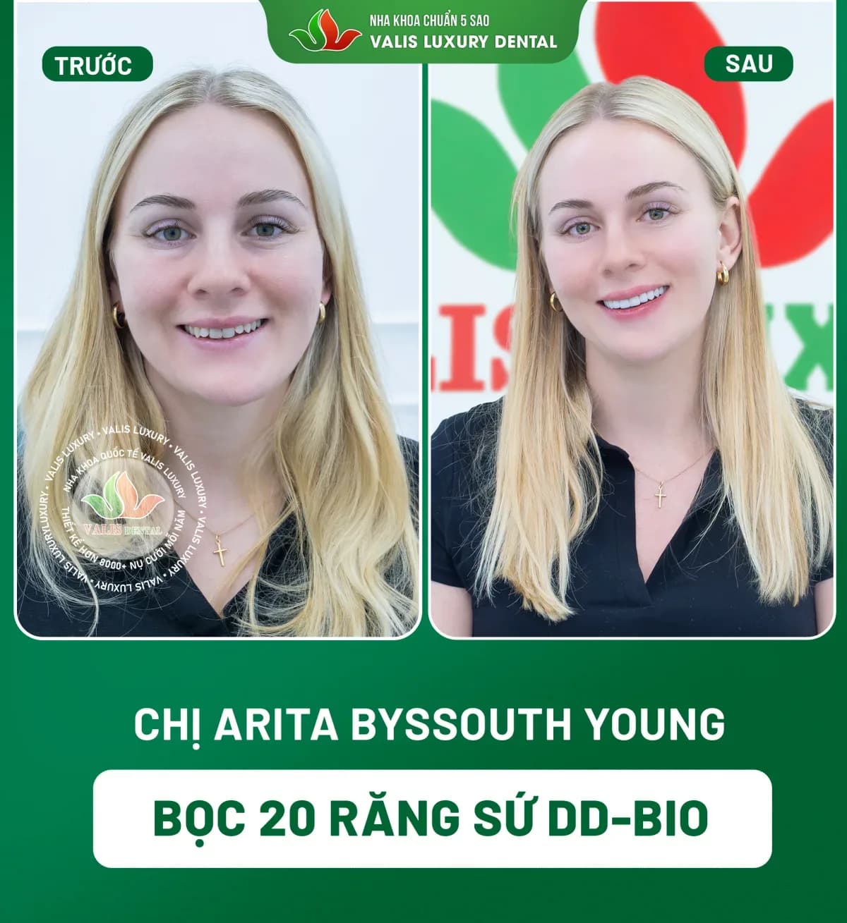 Before and after photographs of Arita Byssouth Young — 20 DD-Bio porcelain crowns at Dental Việt Nam