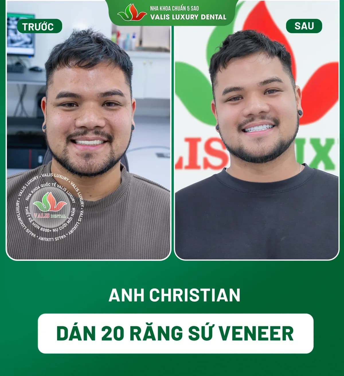 Before and after photographs of Christian — 20 porcelain veneers at Dental Việt Nam