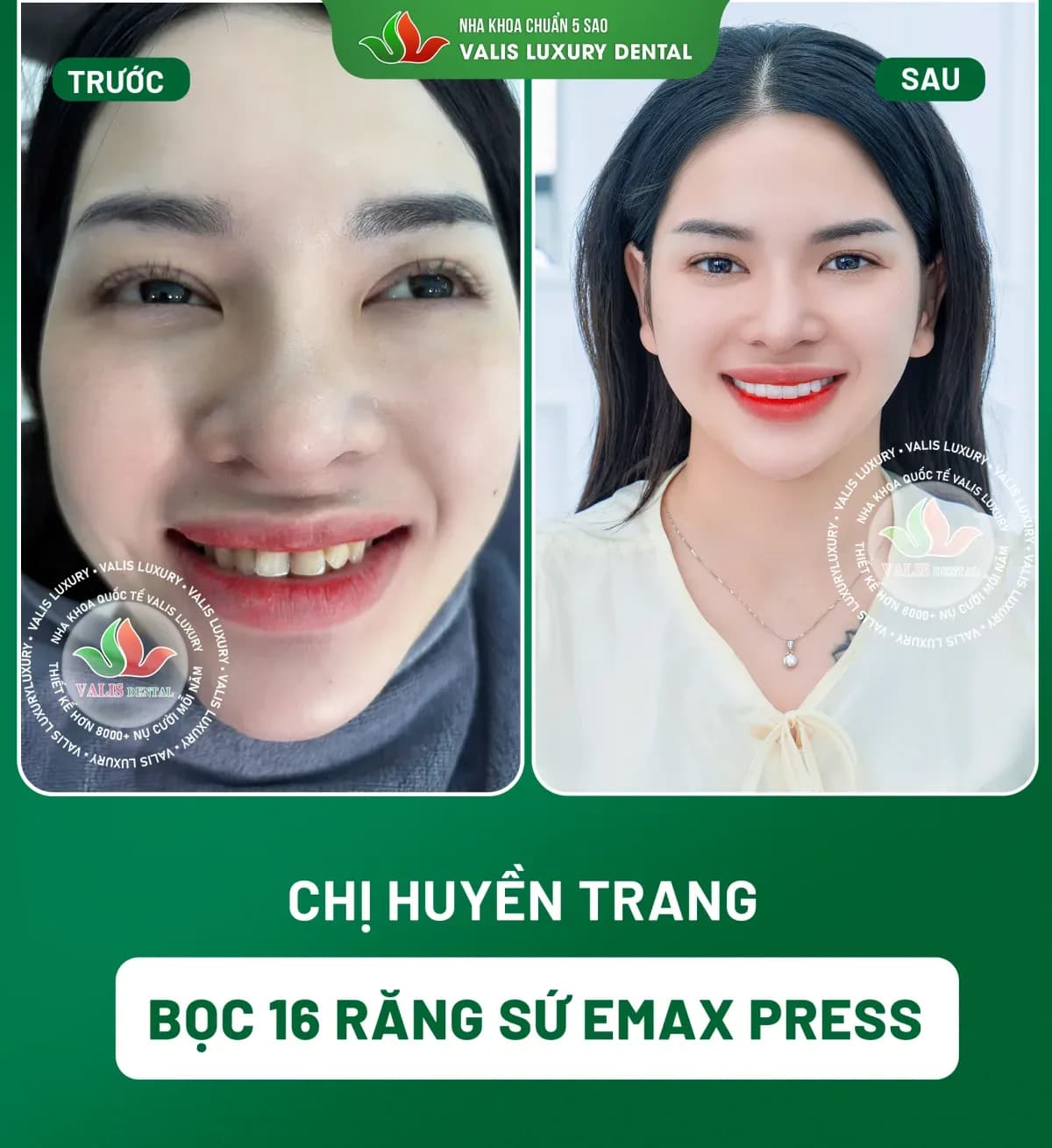 Before and after photographs of Huyền Trang — 16 Emax Press porcelain crowns at Dental Việt Nam