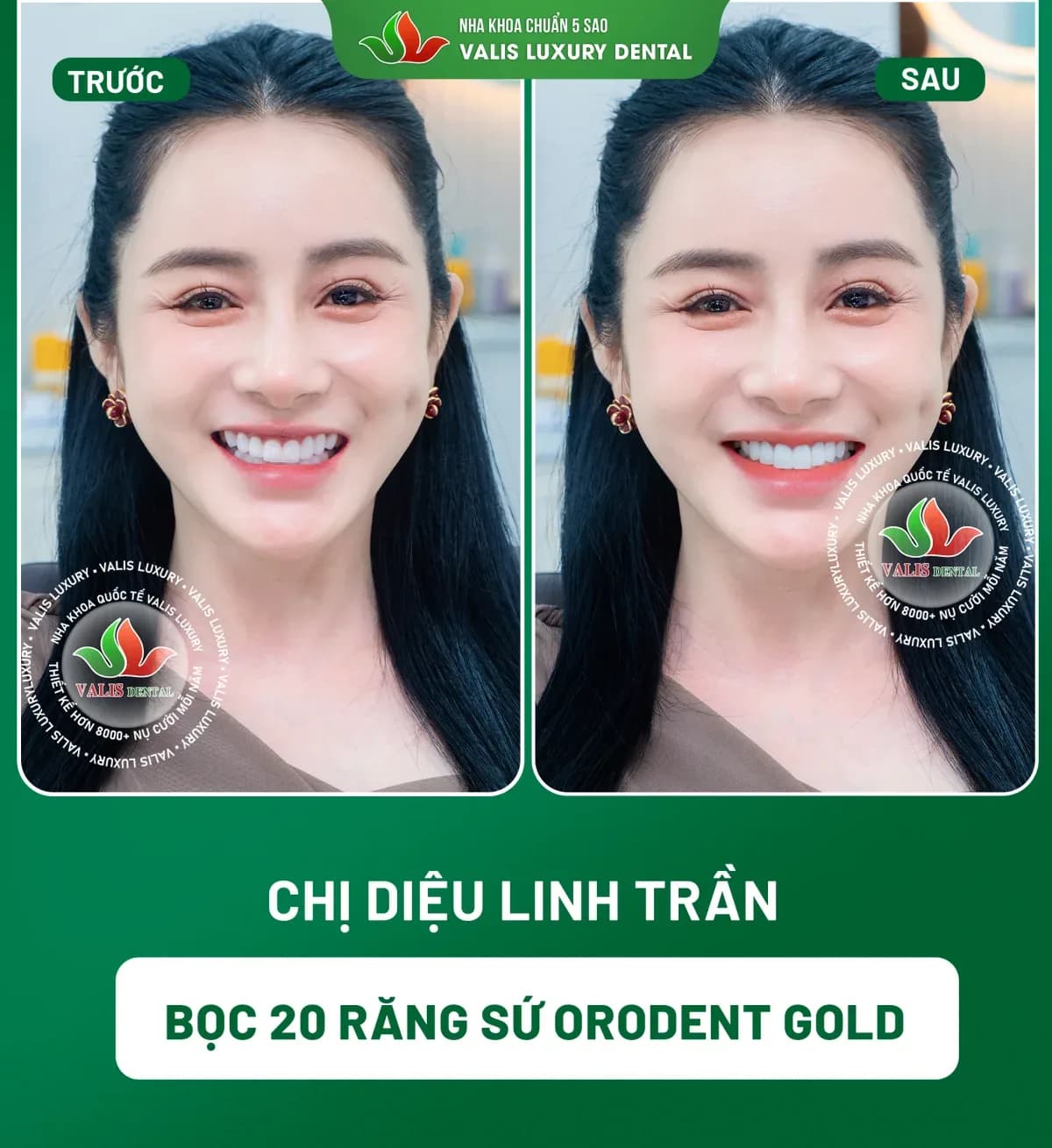 Before and after photographs of Diệu Linh Trần — 20 Orodent Gold porcelain crowns at Dental Việt Nam