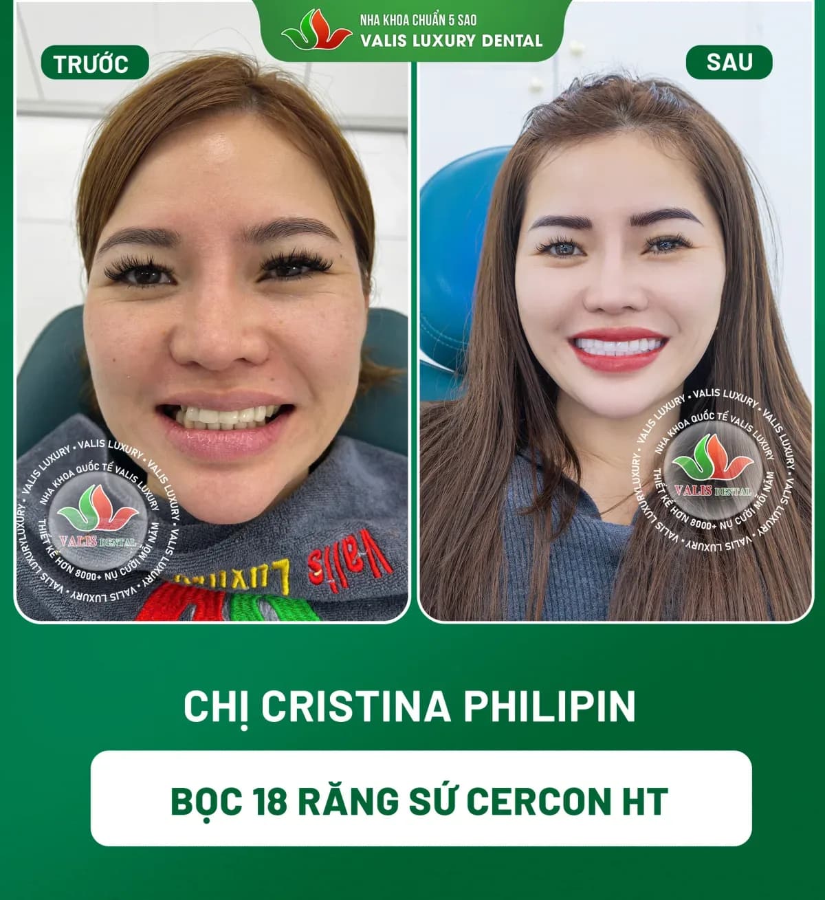 Before and after photographs of Cristina — 18 Cercon HT porcelain crowns at Dental Việt Nam