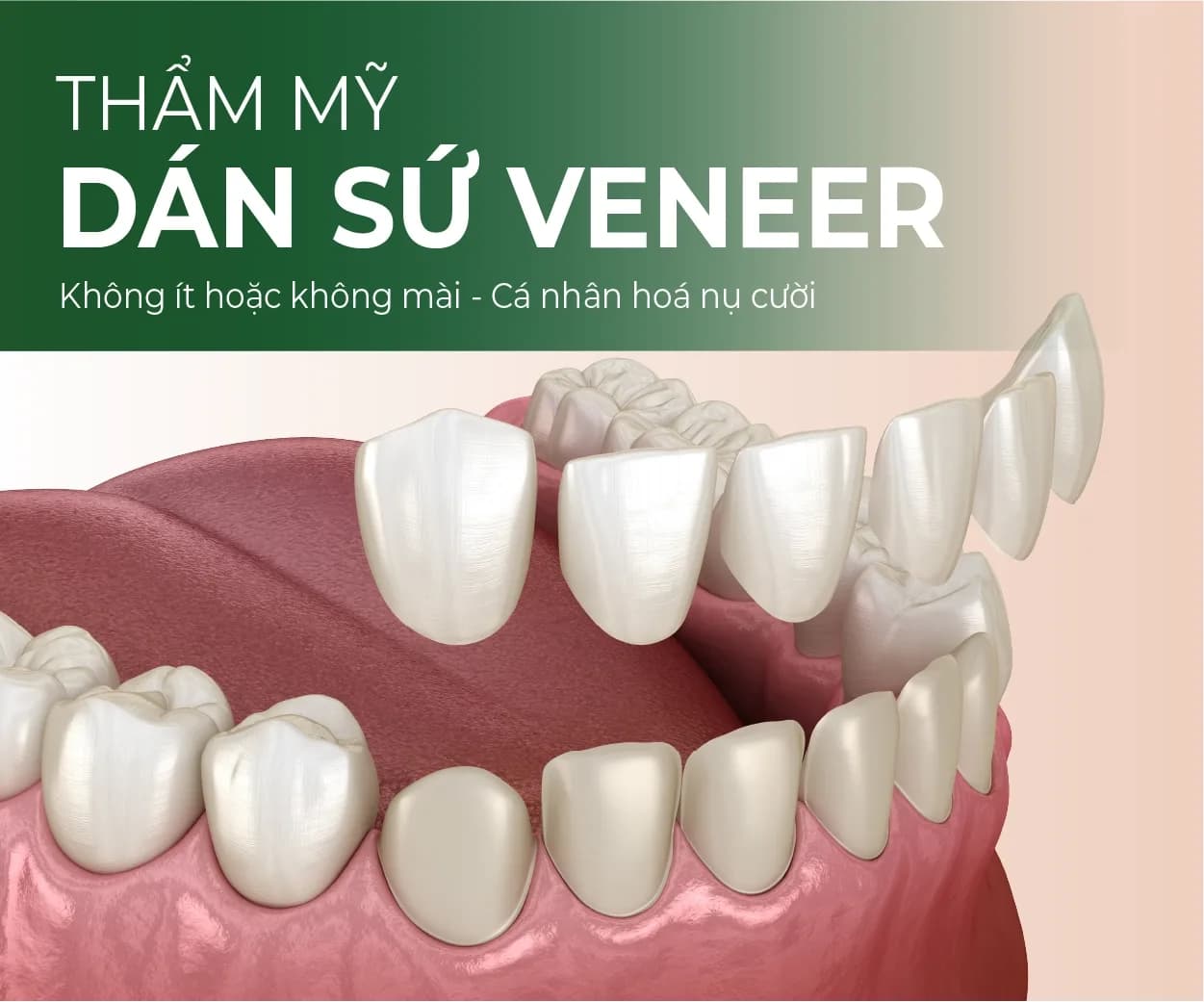 Porcelain veneers illustration