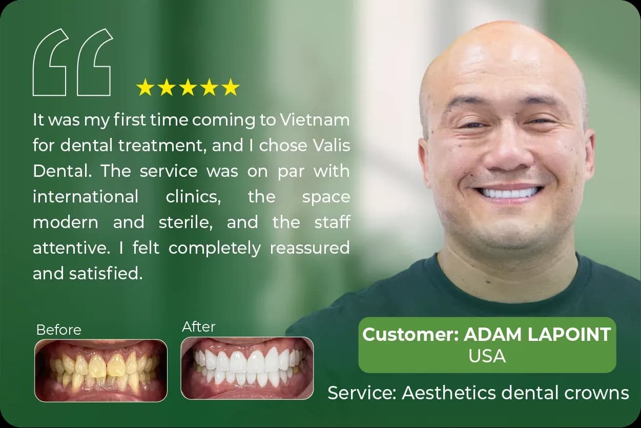Patient story from Adam Lapoint (USA) after porcelain crowns at Dental Việt Nam: “It was my first time coming to Vietnam for dental treatment, and I chose Dental Việt Nam. The service was on par with international clinics, the space modern and sterile, and the staff attentive. I felt completely reassured and satisfied.”