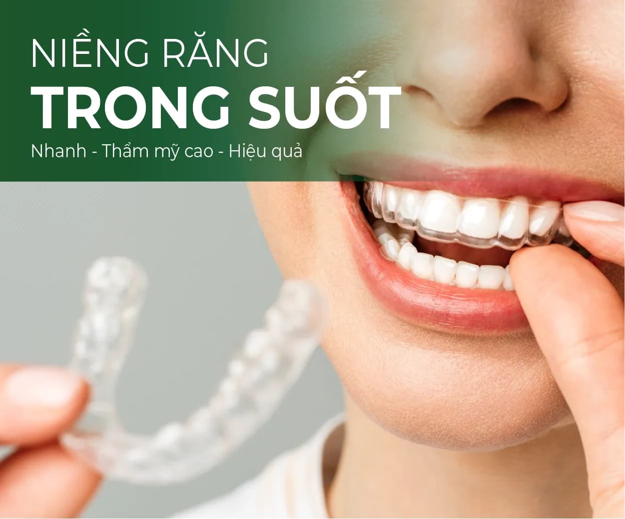 Invisalign clear aligners illustration