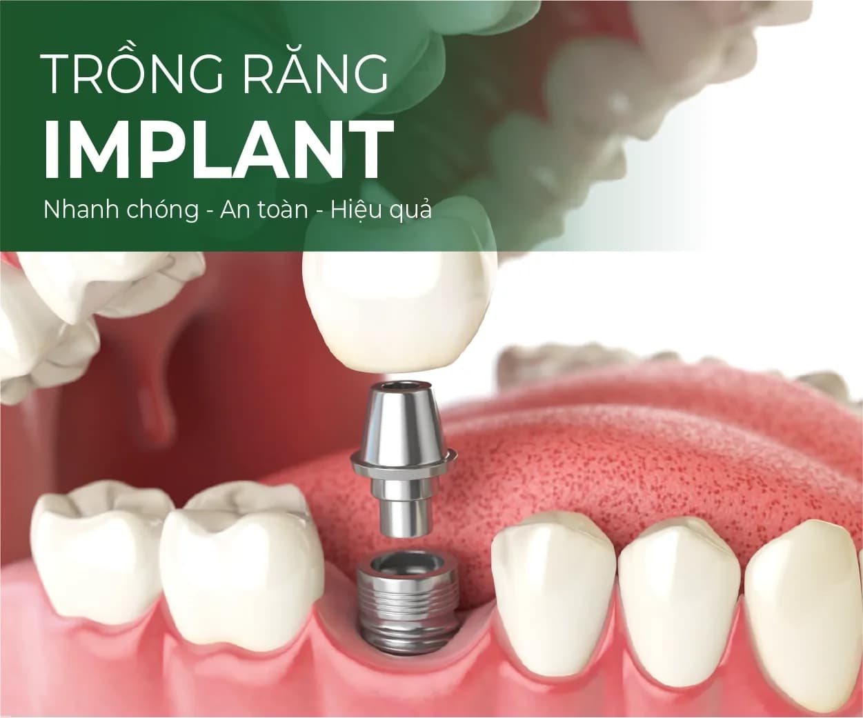 Dental implants illustration